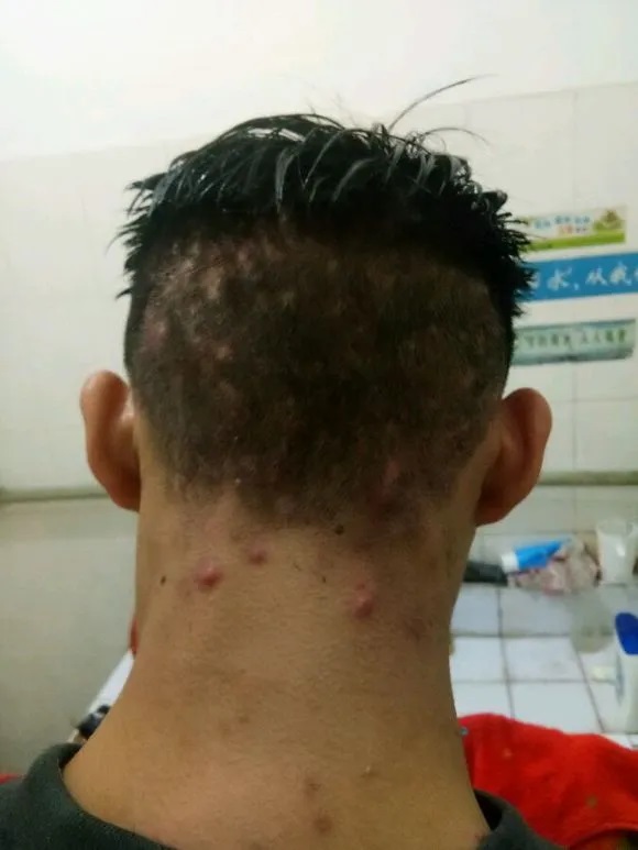 头上有“小颗粒”?可能是毛囊炎