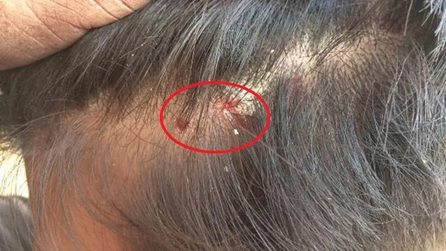 毛囊炎的症状是什么